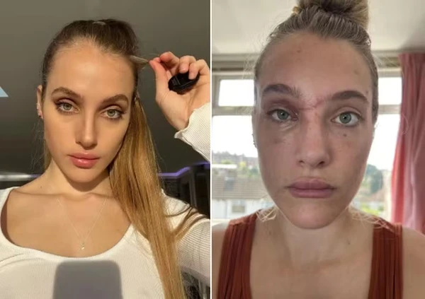 Antes e depois de Mercedes Valentine por Reprodução/Instagram
