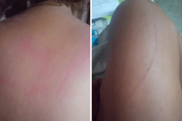 Mulher foi arranhada por criminosos 