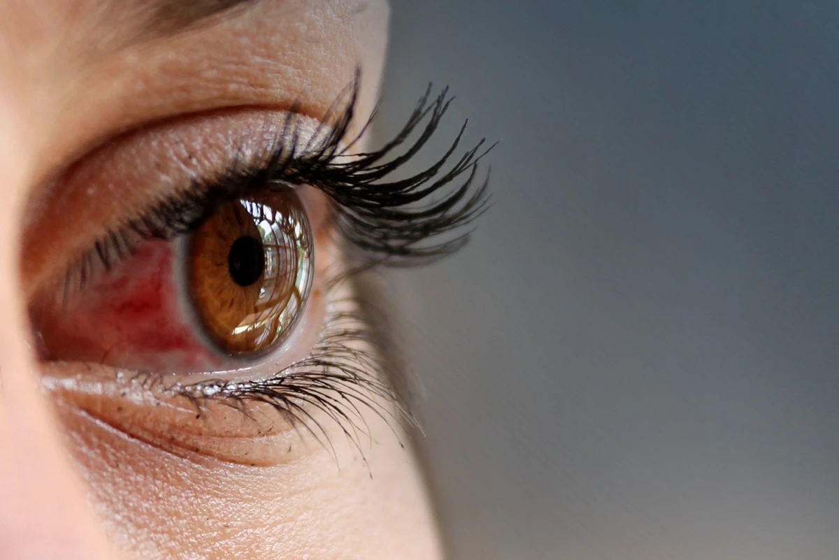 Derrame ocular por Shutterstock