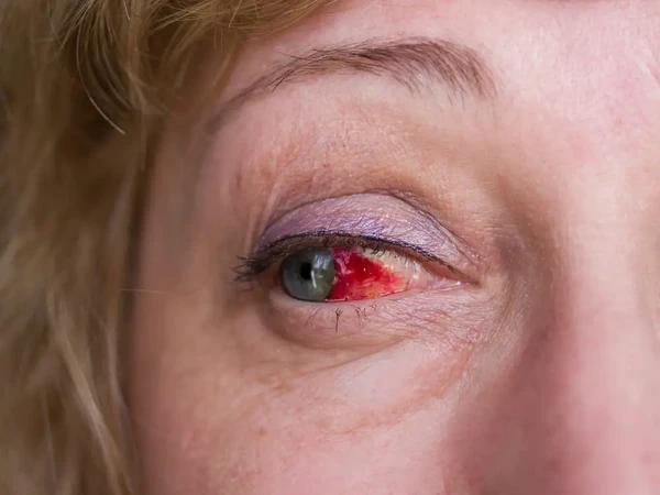 Derrame ocular por Shutterstock