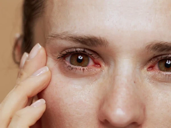 Derrame ocular por Shutterstock