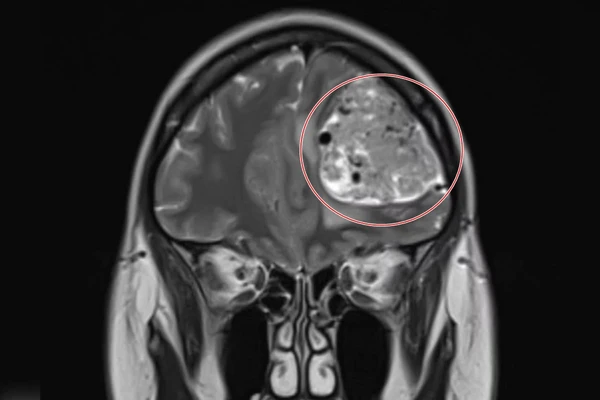 Britânica descobriu tumor