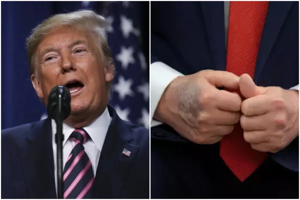 Donald Trump e a mancha em sua mão