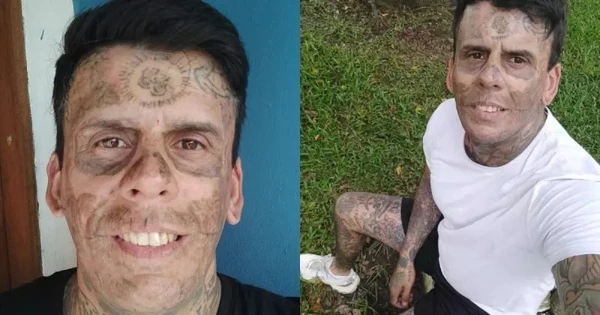 De acordo com os especialistas que acompanham o processo, o tratamento deve ser concluído em cerca de oito sessões, realizadas com intervalo de três meses  por Reprodução/Arquivo Pessoal 