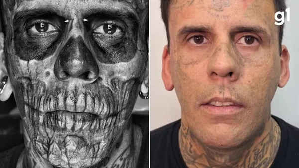 Nas redes sociais, Leandro publicou fotos após a quinta sessão de remoção a laser no rosto, realizada no fim de agosto   por Reprodução/Arquivo Pessoal 