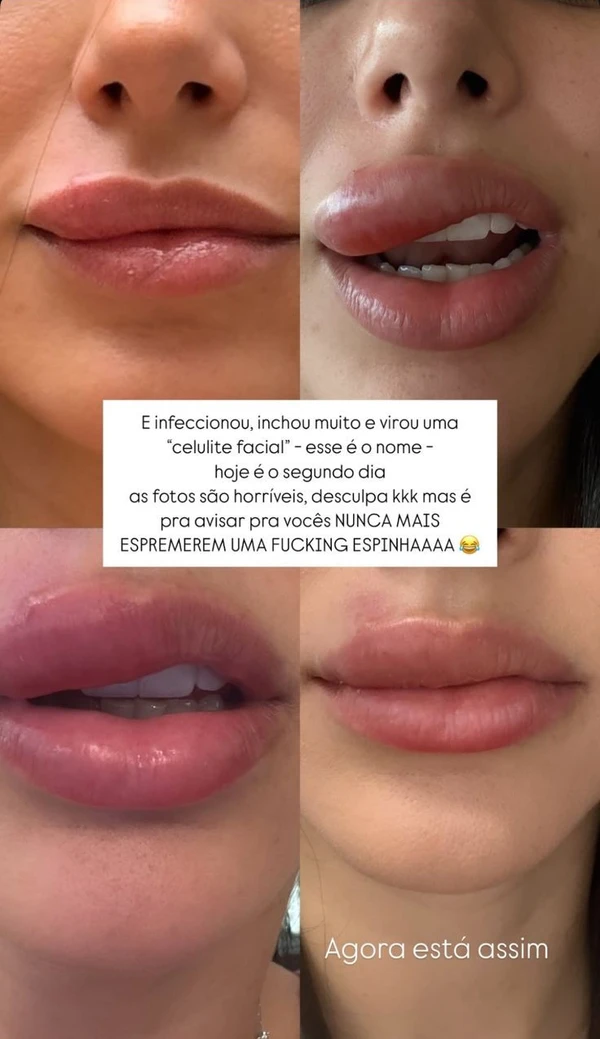 Bruna Biancardi assustou ao mostrar inchaço na boca por Reprodução  Redes Sociais