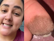 Imagem - Mulher precisa depilar dedo após fazer enxerto com pele da virilha e viraliza nas redes; entenda