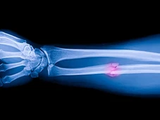 Imagem - Cientistas criam cola que promete tratar ossos quebrados; veja como funciona