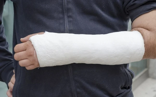 Ossos quebrados, fraturas e gesso por Shutterstock