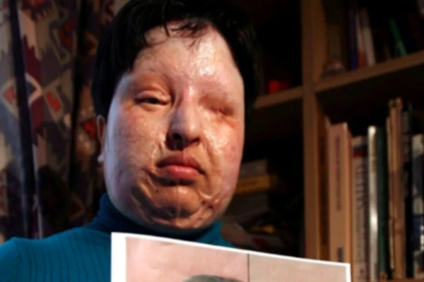 Mulher foi atacada com ácido