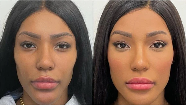 Carol Lekker mostrou o antes e depois da harmonização facial por Reprodução/Redes Sociais 