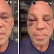 Imagem - Wanderlei Silva diz que perdeu memória e está com forte dor de cabeça após luta com Popó
