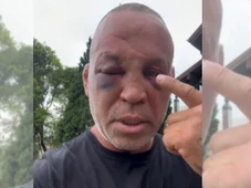 Imagem - Wanderlei Silva revela sequelas de agressão e afirma que irá à Justiça