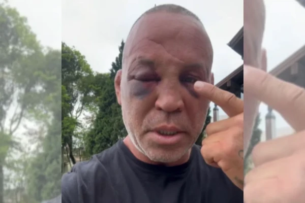 Wanderlei mostrando as sequelas após 