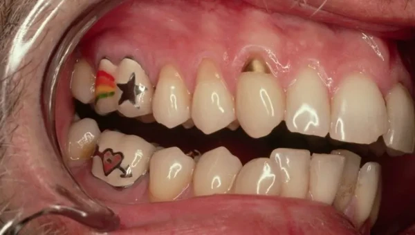 Tatuagem no dente por Reprodução