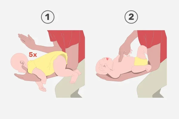  Em bebês, o procedimento é diferente: use palmadas nas costas e compressões no tórax até o engasgo cessar por Reprodução