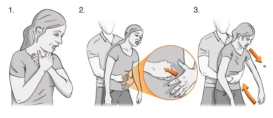 Manobra de Heimlich por Reprodução