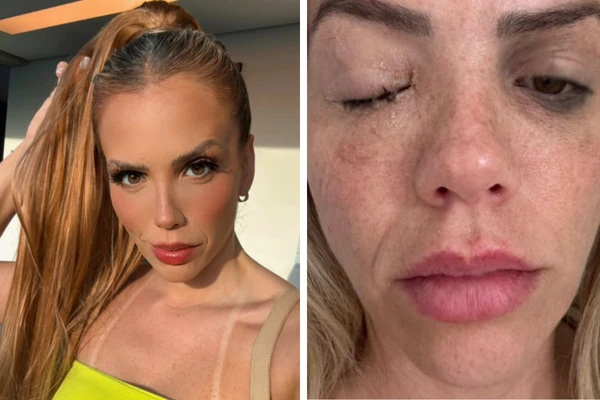 Marcelly Abreu foi diagnosticada com celulite ocular
