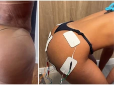 Imagem - Quando o 'bumbum na nuca' vira um risco? Entenda como pode ser a hiperlordose