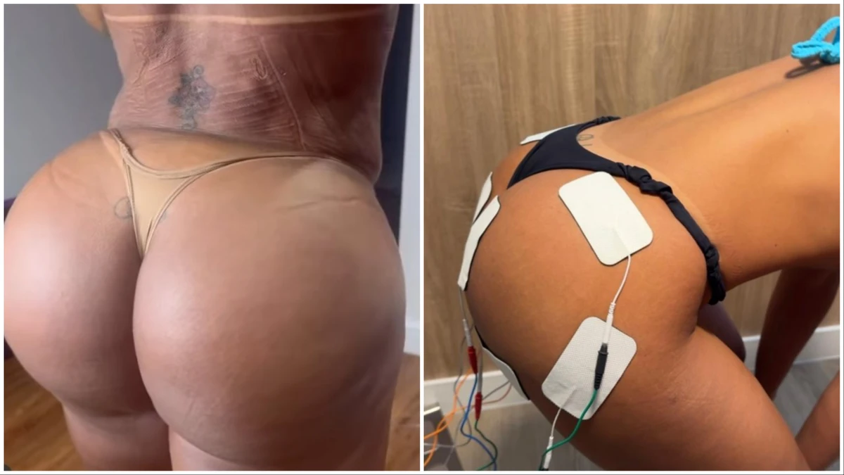 A modelo Gracyanne Barbosa viralizou por conta das imagens do glúteo e da coluna; ao lado, a técnica eletroshape