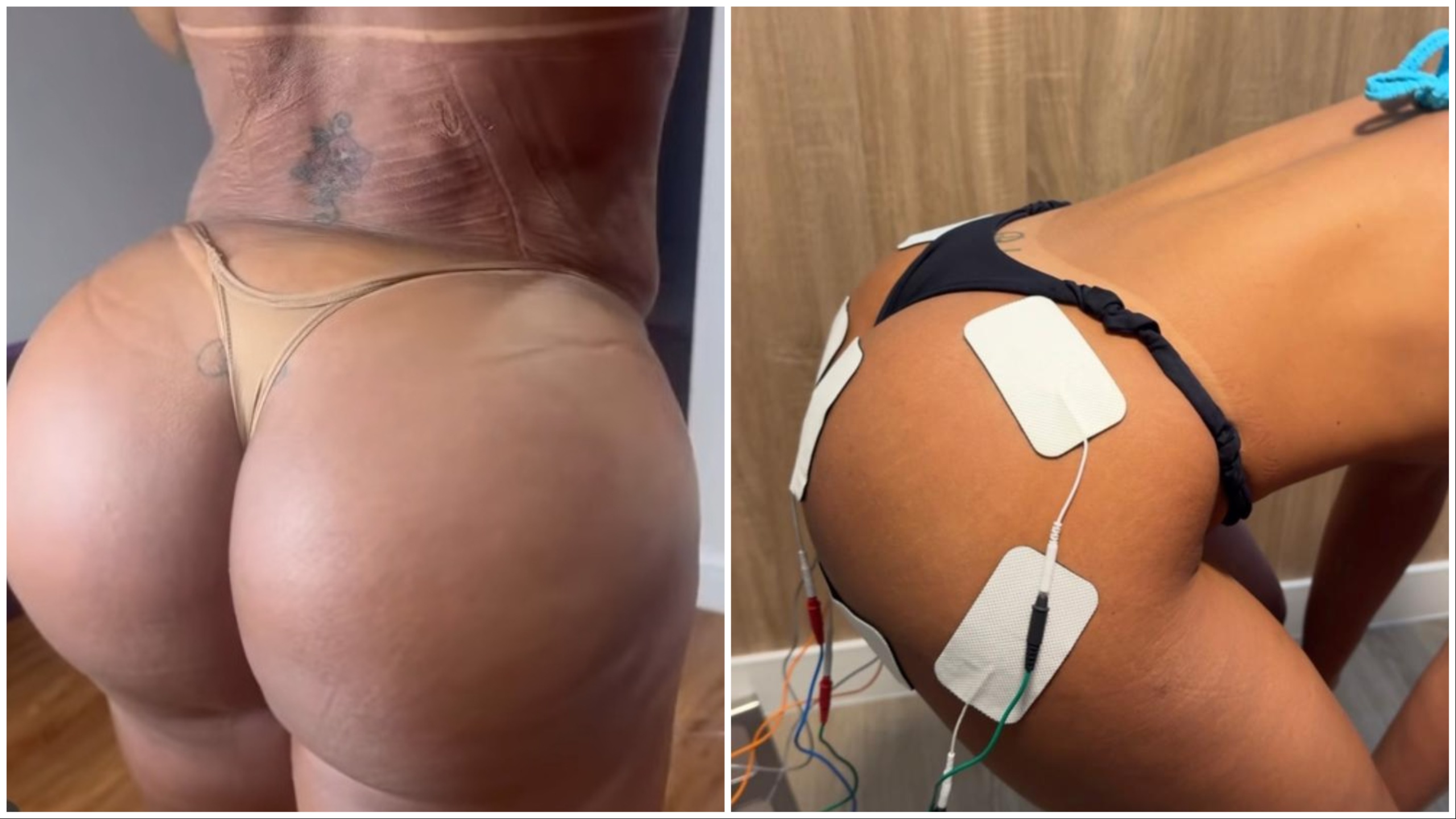 A modelo Gracyanne Barbosa viralizou por conta das imagens do glúteo e da coluna; ao lado, a técnica eletroshape por Reprodução
