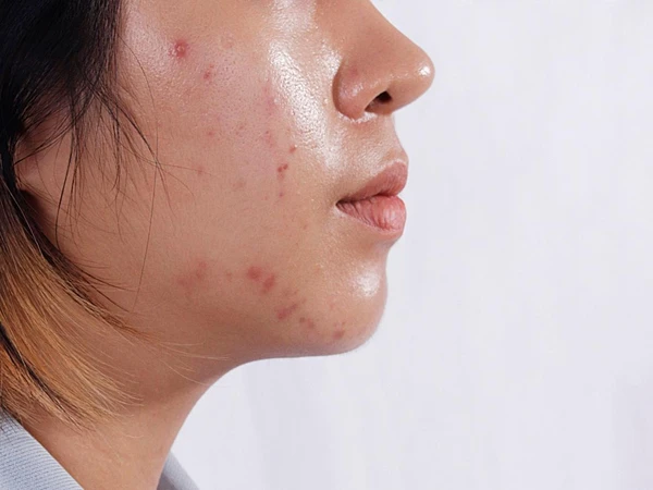 Cravos e espinhas por Shutterstock