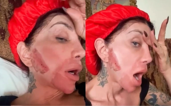 Maya Massafera mostra queimaduras no rosto