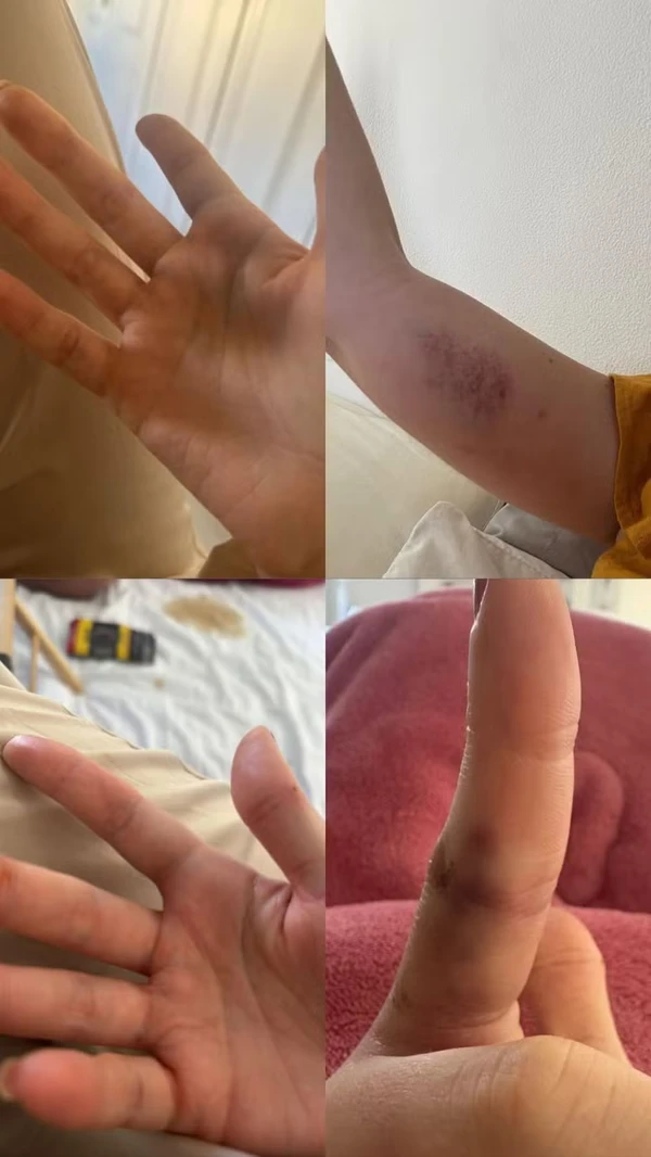 Amiga compartilhou imagens dos ferimentos de Marcela Tomaszewki por Reprodução/Instagram
