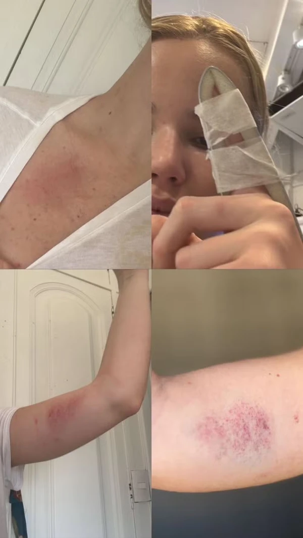 Amiga compartilhou imagens dos ferimentos de Marcela Tomaszewki por Reprodução/Instagram