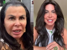 Imagem - Gretchen desabafa após diagnóstico de alopecia: ‘Não tenho mais cabelo’