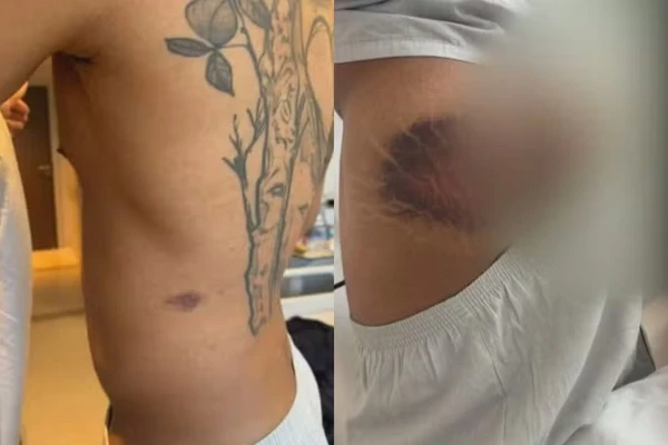 Soldado ficou com hematomas no corpo