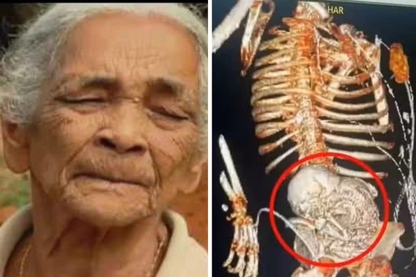 Colombiana de 82 anos procurou o hospital com fortes dores no estômago