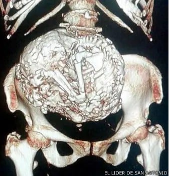 Litopedia ou bebê de pedra por Reprodução