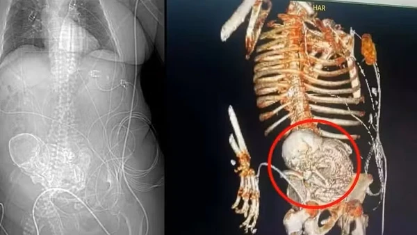 Litopedia ou bebê de pedra por Reprodução