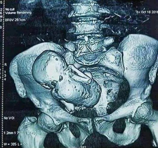 Litopedia ou bebê de pedra por Reprodução