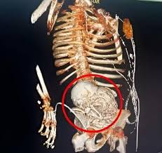 Litopedia ou bebê de pedra por Reprodução