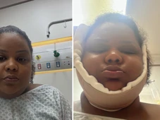 Imagem - MC Carol compartilha resultado da lipo de papada; veja como ficou