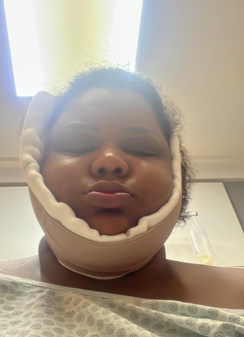 MC Carol: processo de recuperação da 'lipo de papada' por Reprodução / Redes Sociais