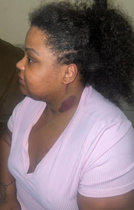 MC Carol: processo de recuperação da 'lipo de papada' por Reprodução / Redes Sociais