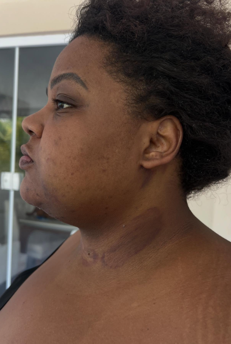 MC Carol: processo de recuperação da 'lipo de papada' por Reprodução / Redes Sociais