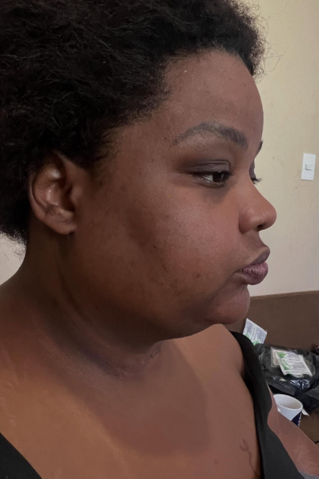 MC Carol: processo de recuperação da 'lipo de papada' por Reprodução / Redes Sociais