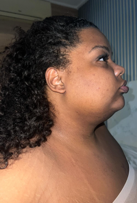 MC Carol: processo de recuperação da 'lipo de papada' por Reprodução / Redes Sociais