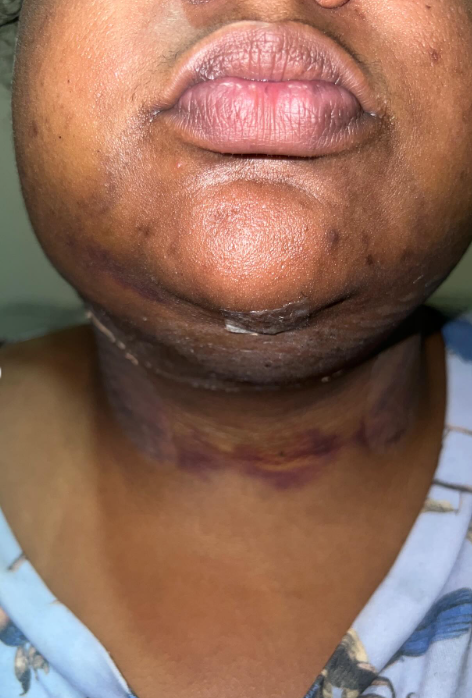 MC Carol: processo de recuperação da 'lipo de papada' por Reprodução / Redes Sociais