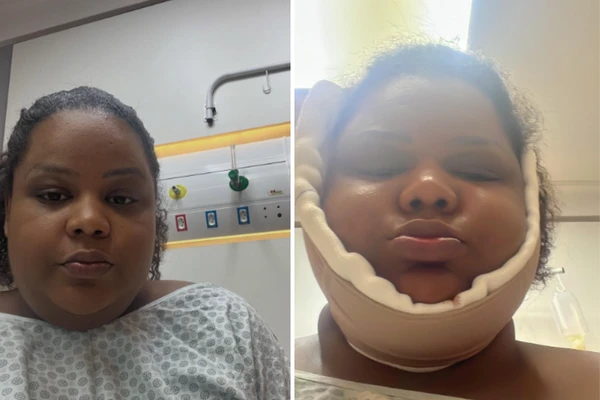 MC Carol realizou lipo de papada