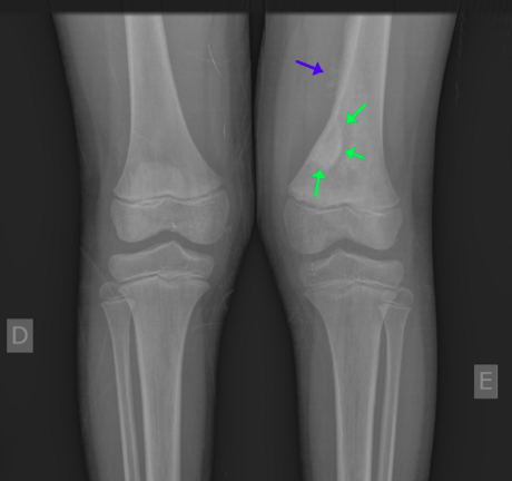 Ossos também podem ser atingidos por tumores malignos por Reprodução