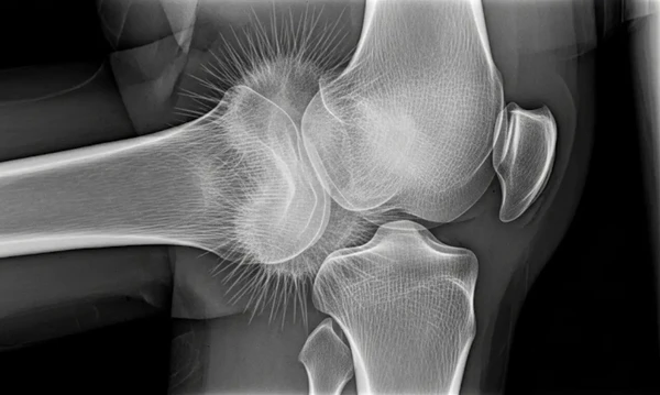 Ossos também podem ser atingidos por tumores malignos por Reprodução