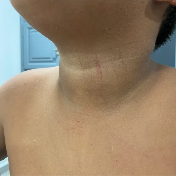 Criança brasileira tem dois dedos amputados por colegas de escola em Portugal: 'eu achava que ia morrer' por Reprodução