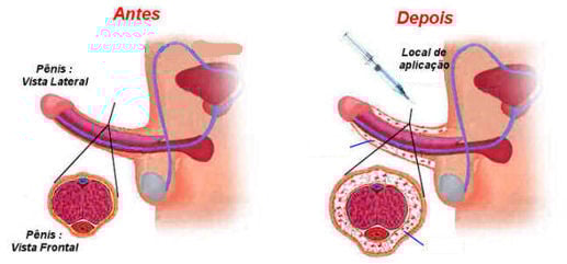 Harmonização peniana por Divulgação