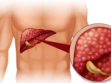 Imagem - O exercício físico que realmente queima gordura e limpa o fígado em poucos dias