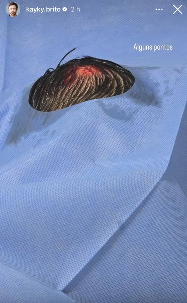  Kayky Brito exibe ferimentos após queda de bicicleta por Reprodução/Instagram